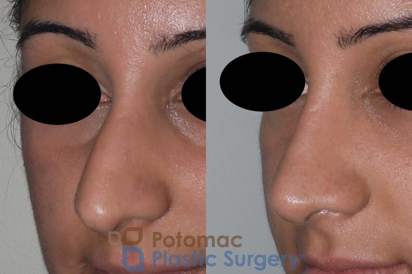 Before & After Rhinoplasty - Cosmetic Case 147 Left Oblique View in Washington DC & Arlington , DC