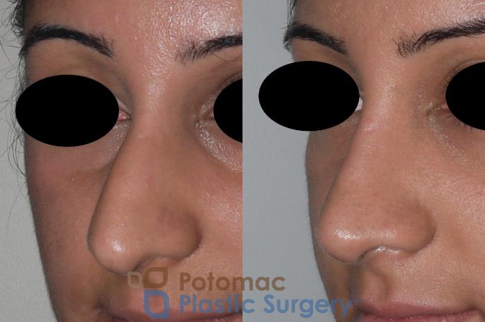 Before & After Rhinoplasty - Cosmetic Case 147 Left Oblique View in Washington, DC