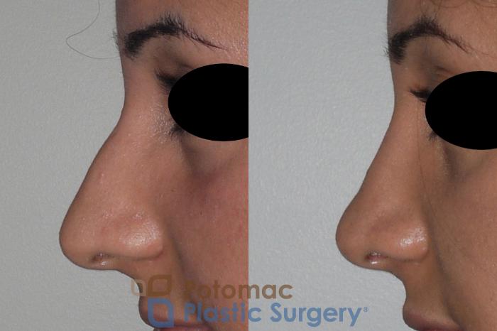 Before & After Rhinoplasty - Cosmetic Case 147 Left Side View in Washington, DC