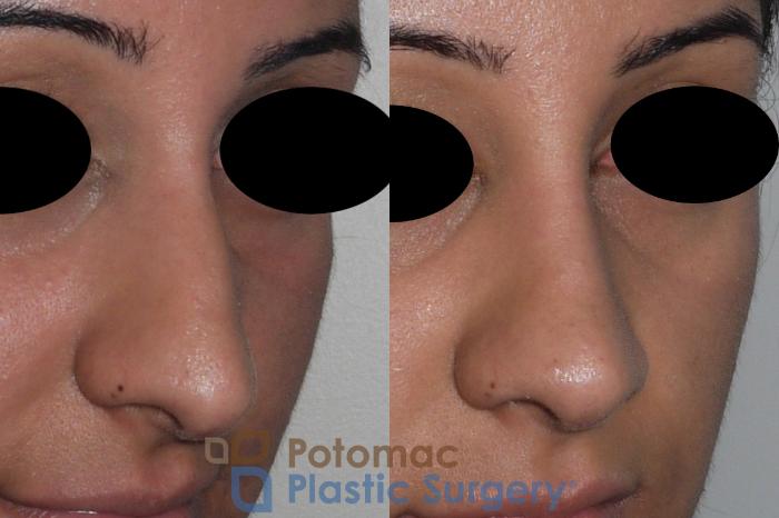Before & After Rhinoplasty - Cosmetic Case 147 Right Oblique View in Washington, DC