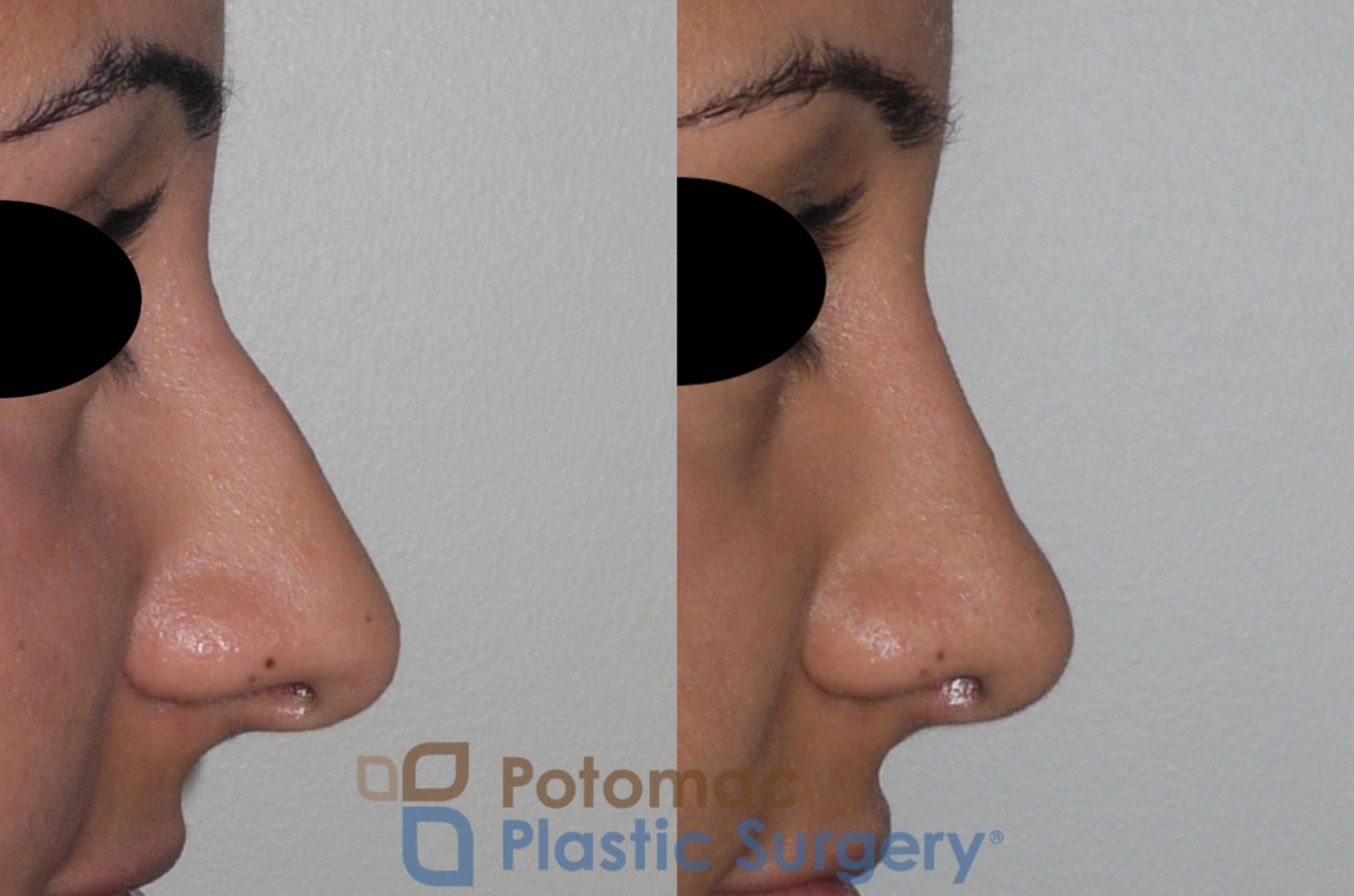 Before & After Rhinoplasty - Cosmetic Case 147 Right Side View in Washington DC & Arlington , DC