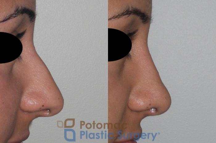Before & After Rhinoplasty - Cosmetic Case 147 Right Side View in Washington, DC