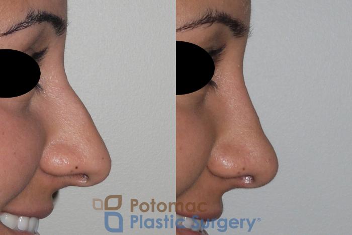 Before & After Rhinoplasty - Cosmetic Case 147 Right Side View #2 View in Washington, DC