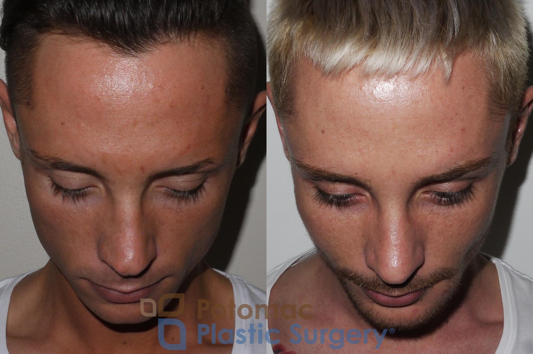Before & After Rhinoplasty - Cosmetic Case 152 Above View in Washington, DC