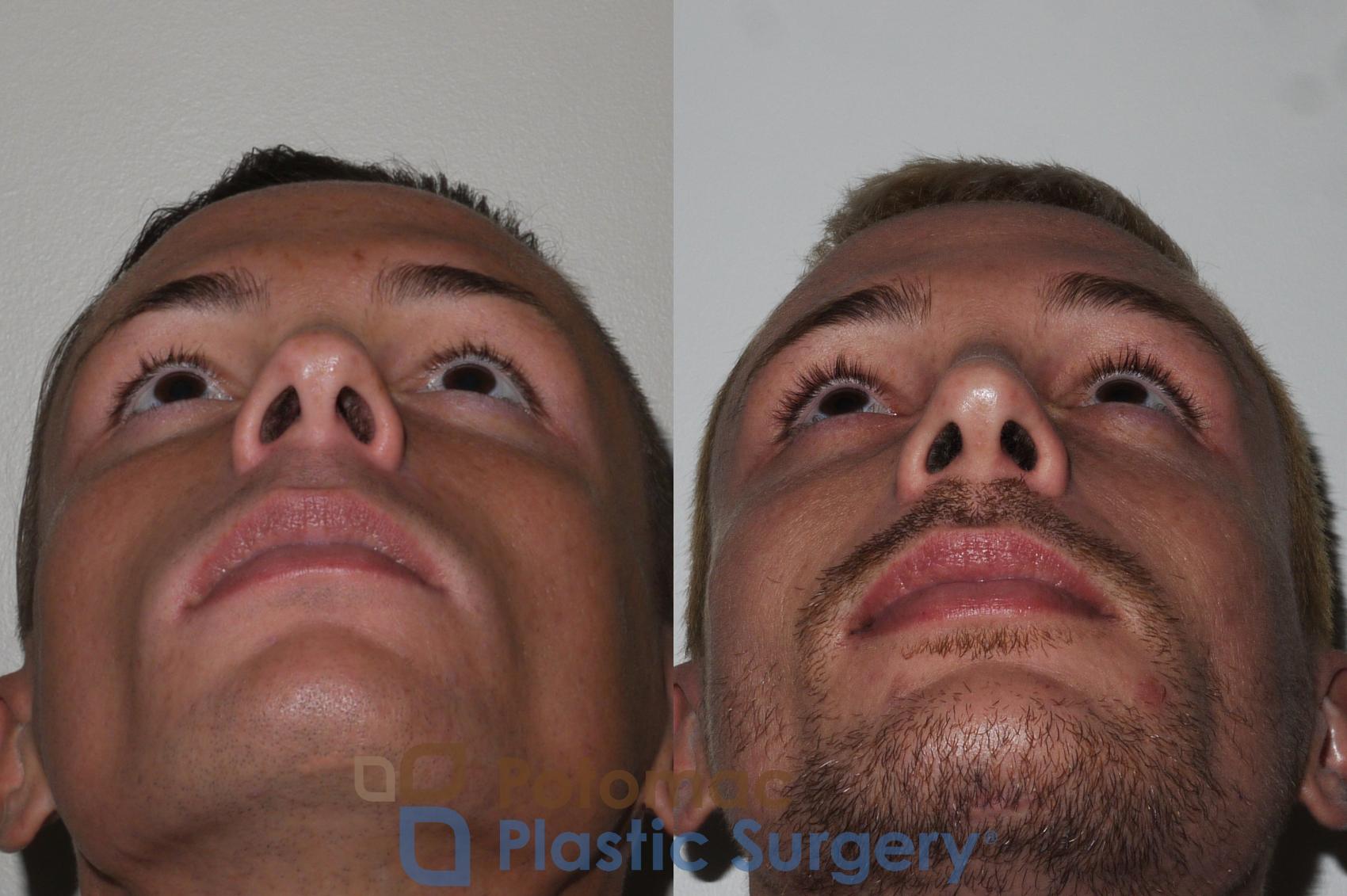 Before & After Rhinoplasty - Cosmetic Case 152 Below View in Washington, DC