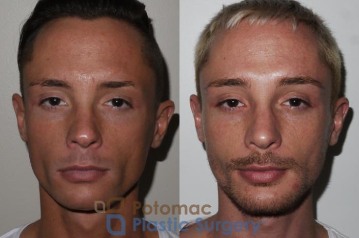 Before & After Chin Augmentation Case 152 Front View in Washington, DC