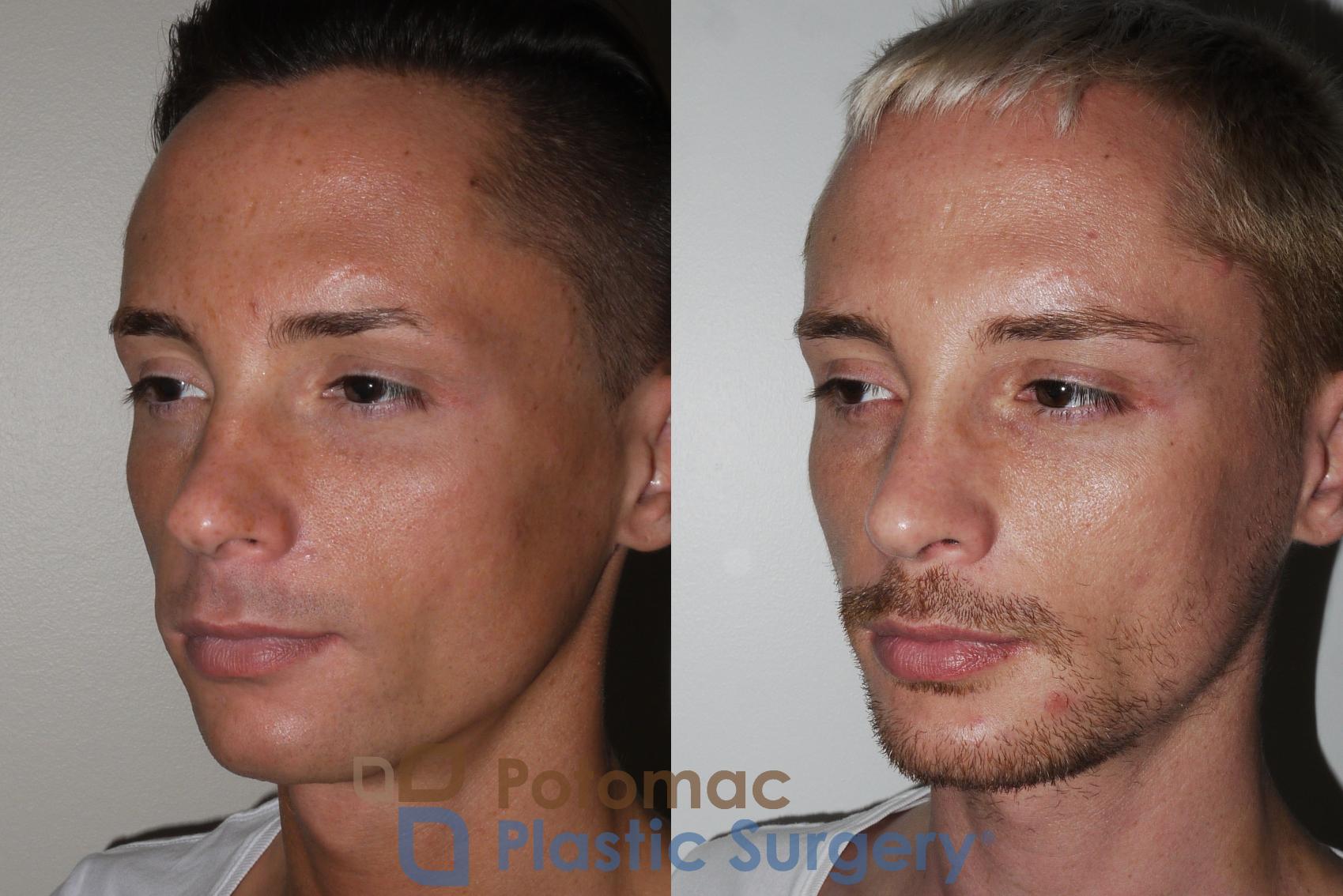 Before & After Rhinoplasty - Cosmetic Case 152 Left Oblique View in Washington, DC