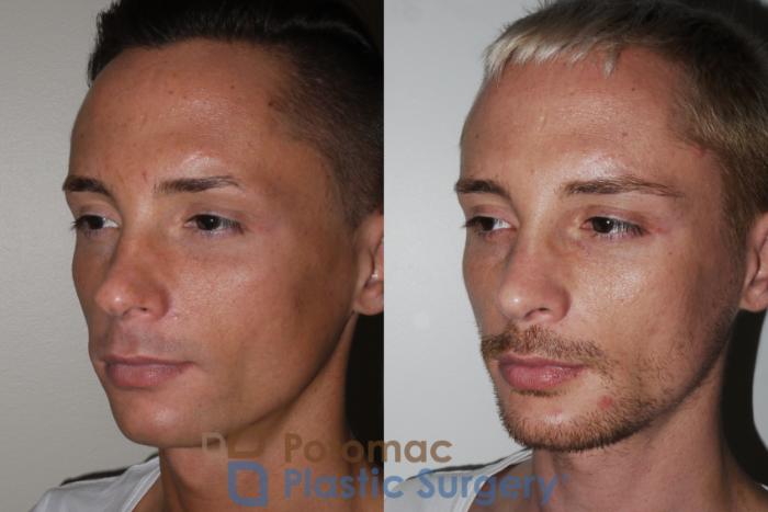 Before & After Chin Augmentation Case 152 Left Oblique View in Washington DC & Arlington , DC