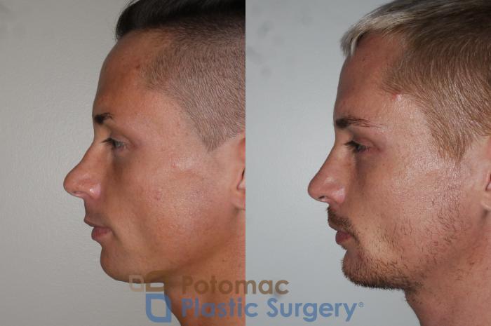 Before & After Chin Augmentation Case 152 Left Side View in Washington DC & Arlington , DC