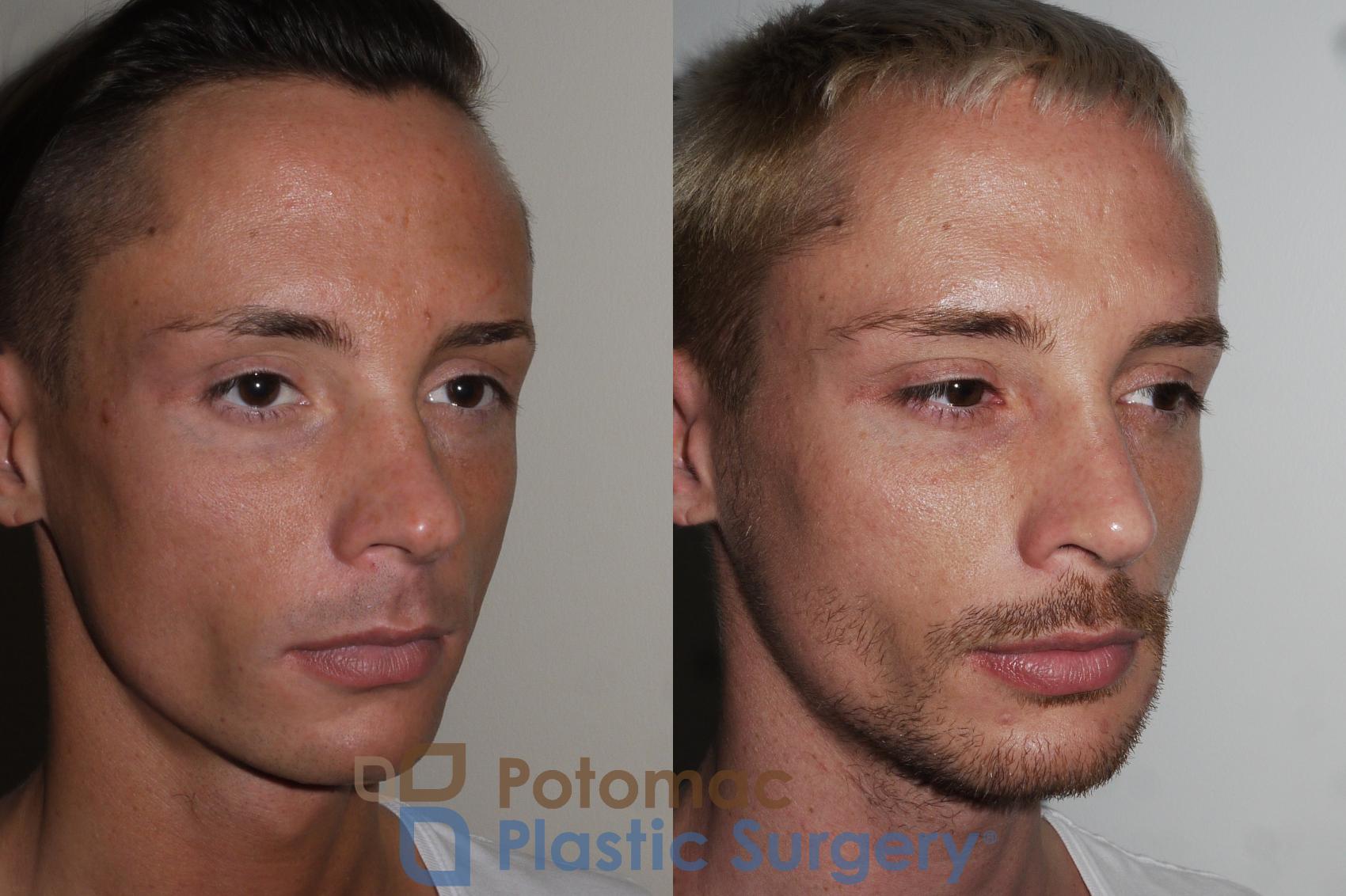 Before & After Rhinoplasty - Cosmetic Case 152 Right Oblique View in Washington, DC