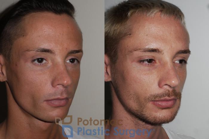 Before & After Facial Sculpting Case 152 Right Oblique View in Washington DC & Arlington , DC