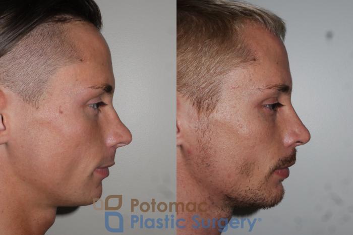 Before & After Chin Augmentation Case 152 Right Side View in Washington DC & Arlington , DC