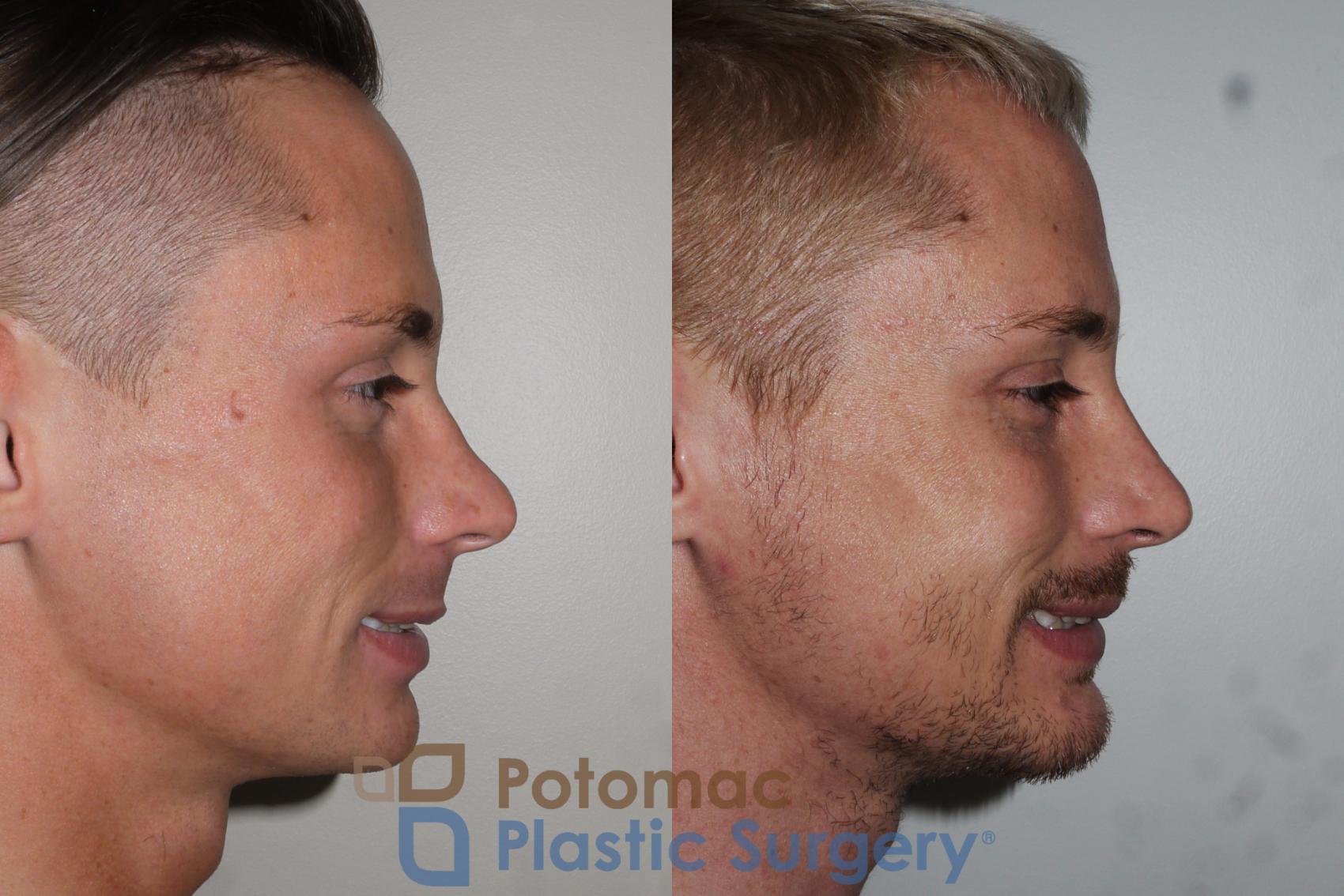 Before & After Rhinoplasty - Cosmetic Case 152 Right Side View #2 View in Washington, DC