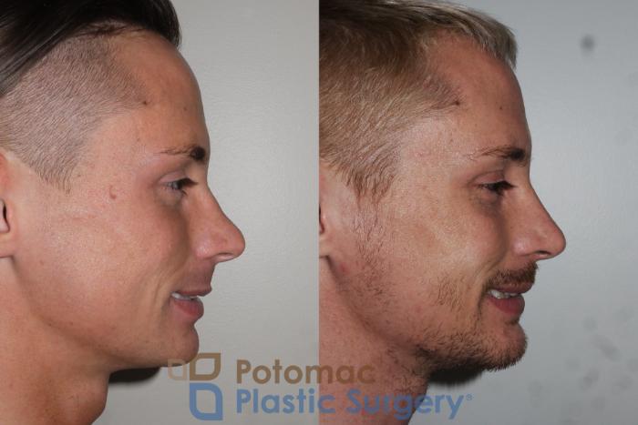 Before & After Chin Augmentation Case 152 Right Side View #2 View in Washington DC & Arlington , DC