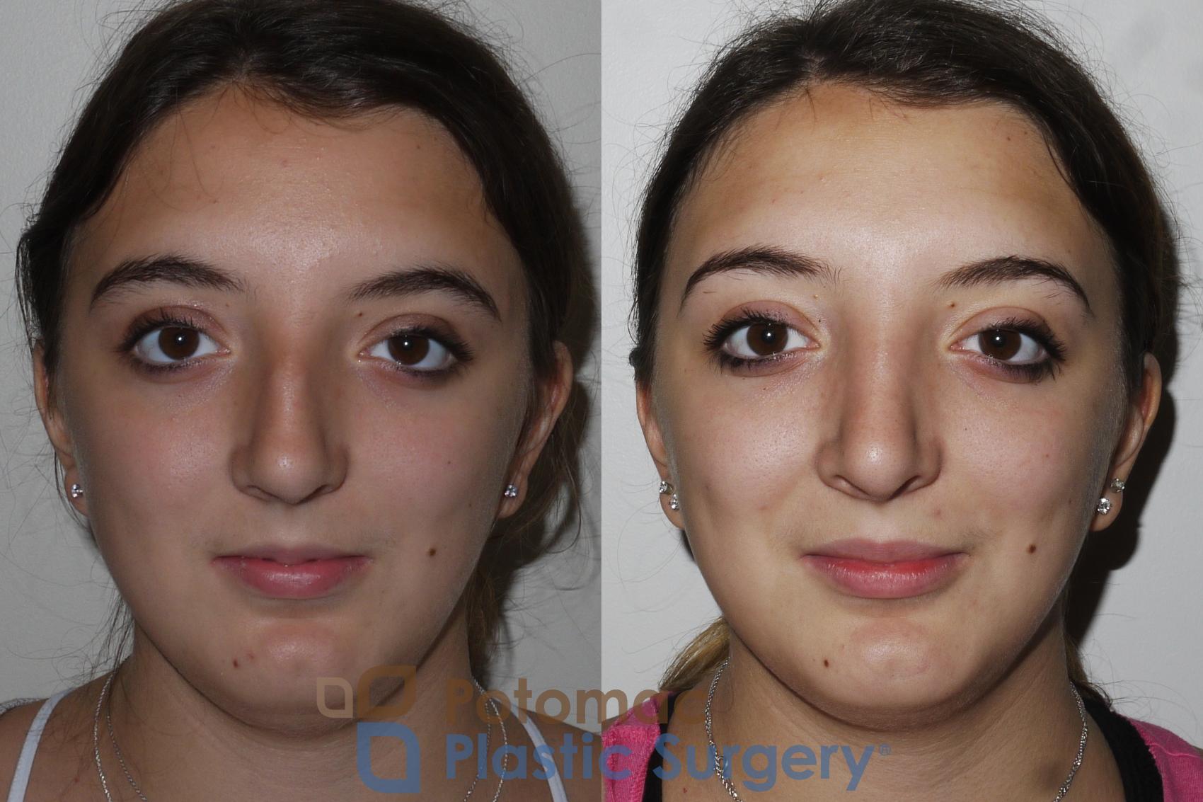 Before & After Rhinoplasty - Cosmetic Case 153 Front View in Washington, DC