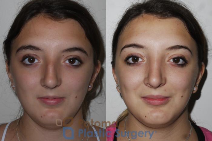 Before & After Rhinoplasty - Cosmetic Case 153 Front View in Washington DC & Arlington , DC