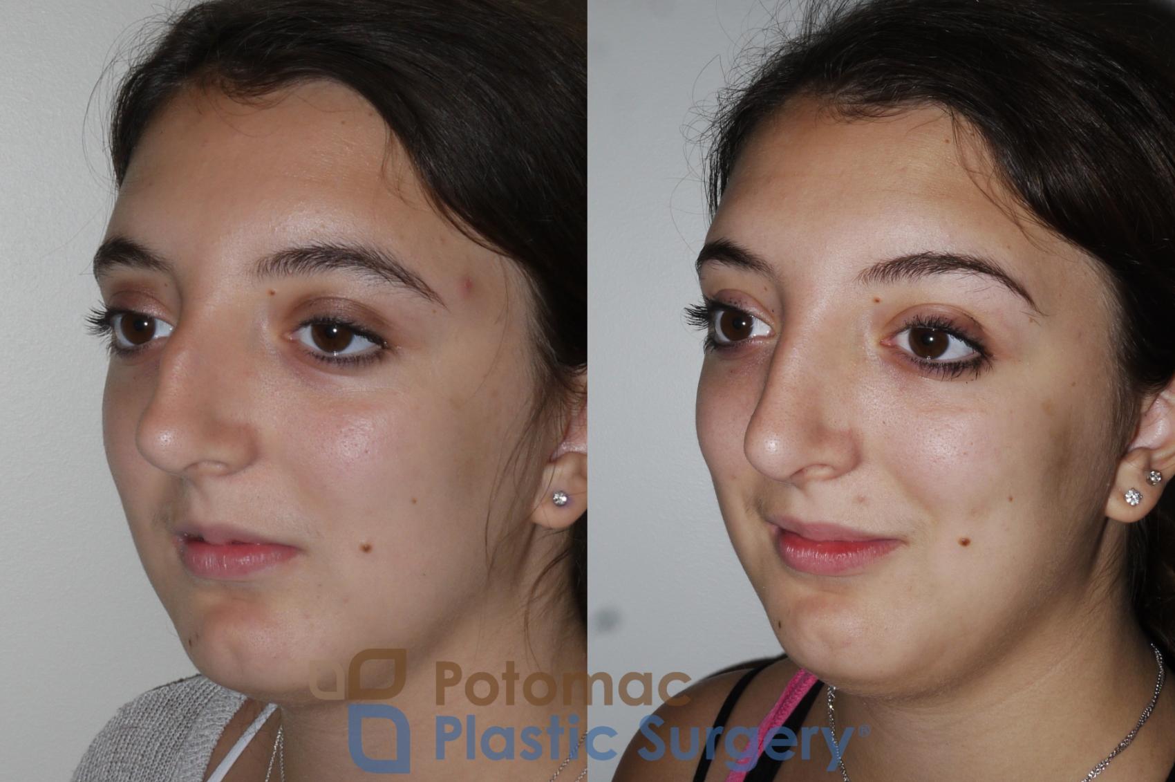 Before & After Rhinoplasty - Cosmetic Case 153 Left Oblique View in Washington, DC