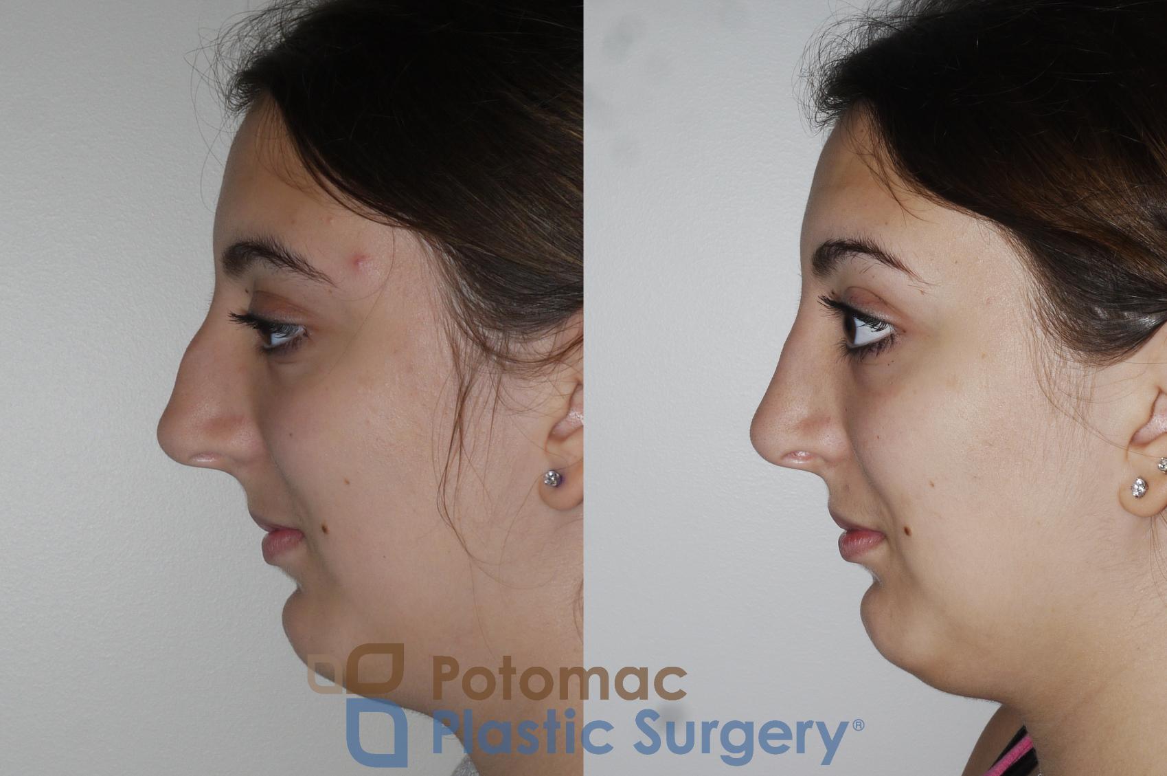 Before & After Rhinoplasty - Cosmetic Case 153 Left Side View in Washington, DC