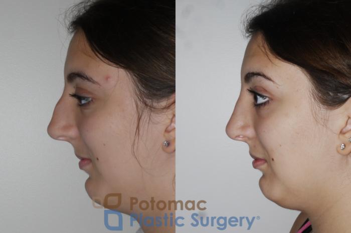 Before & After Rhinoplasty - Cosmetic Case 153 Left Side View in Washington DC & Arlington , DC