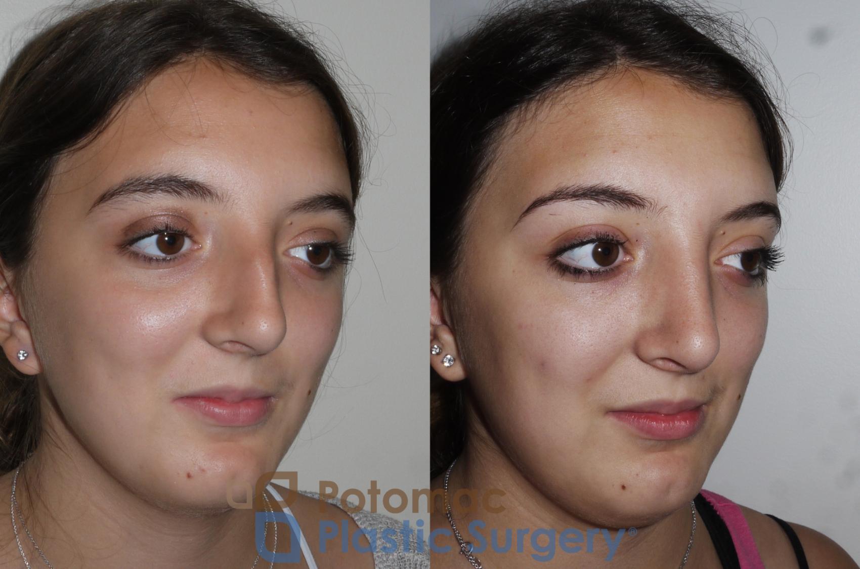 Before & After Rhinoplasty - Cosmetic Case 153 Right Oblique View in Washington, DC