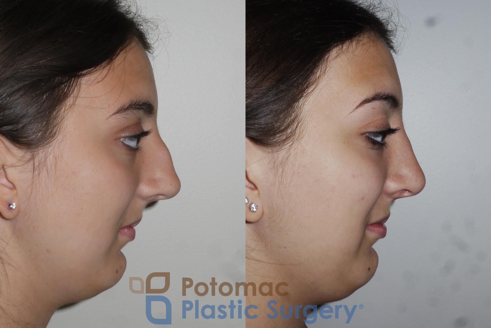 Before & After Rhinoplasty - Cosmetic Case 153 Right Side View in Washington, DC