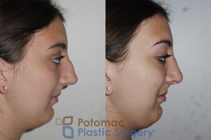 Before & After Rhinoplasty - Cosmetic Case 153 Right Side View in Washington DC & Arlington , DC