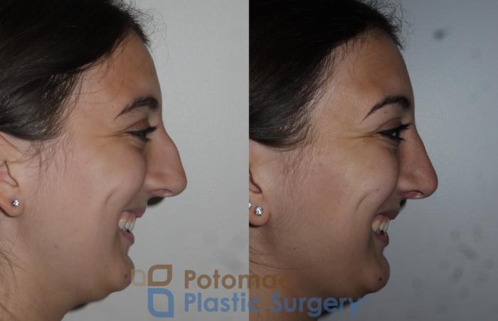 Before & After Rhinoplasty - Cosmetic Case 153 Right Side View #2 View in Washington DC & Arlington , DC