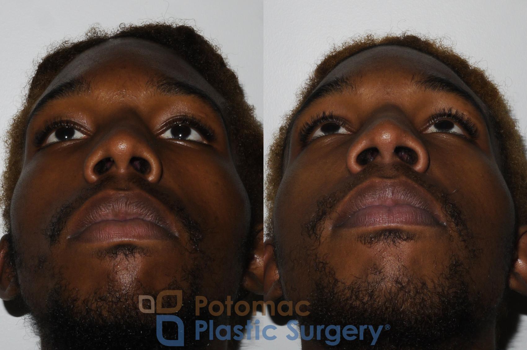 Before & After Rhinoplasty - Cosmetic Case 161 Bottom View in Washington DC & Arlington , DC