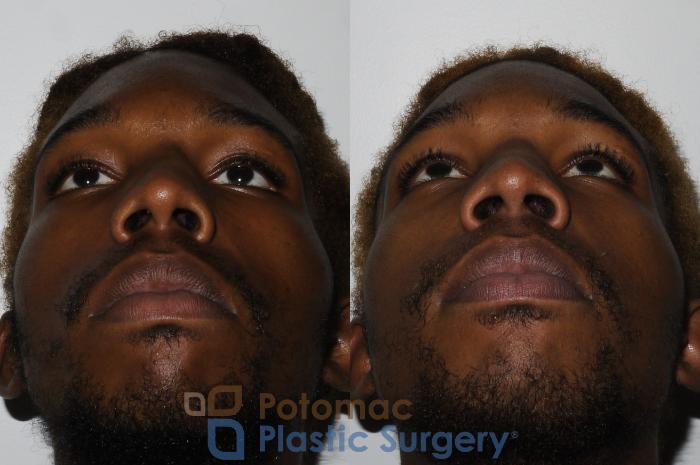 Before & After Rhinoplasty - Medical Case 161 Bottom View in Washington DC & Arlington , DC