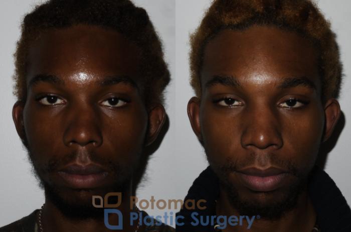 Before & After Rhinoplasty - Medical Case 161 Front View in Washington DC & Arlington , DC