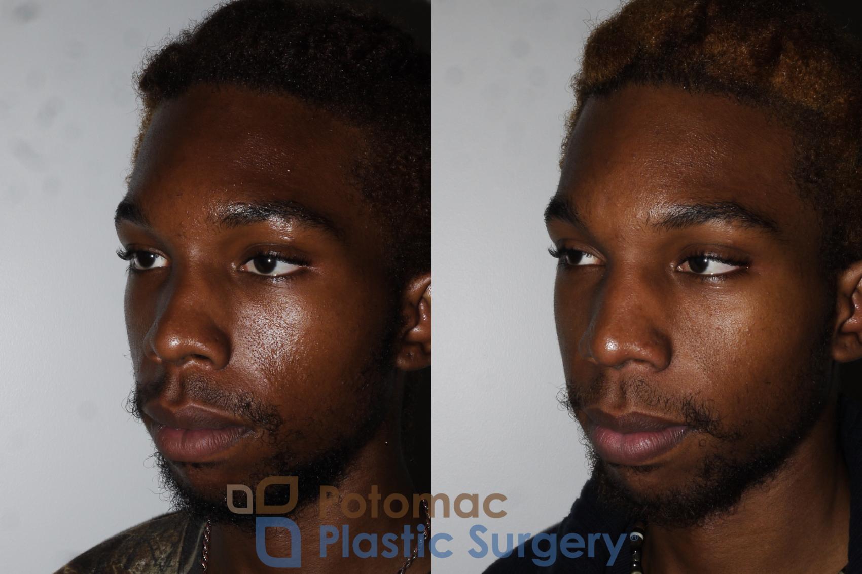 Before & After Rhinoplasty - Cosmetic Case 161 Left Oblique View in Washington DC & Arlington , DC