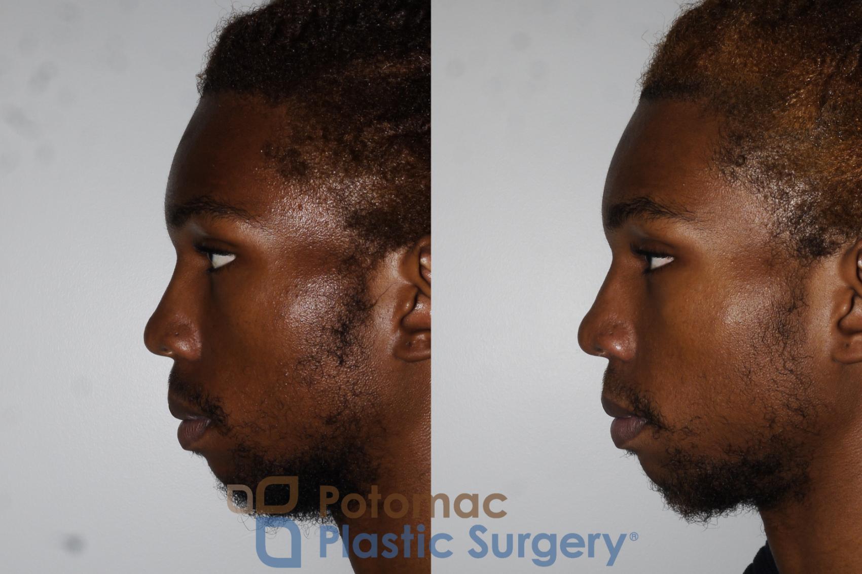 Before & After Rhinoplasty - Cosmetic Case 161 Left Side View in Washington DC & Arlington , DC