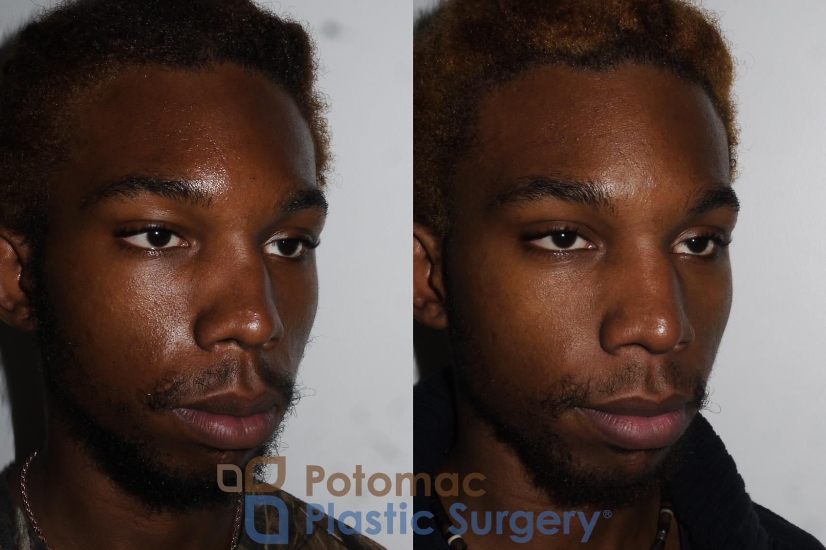 Before & After Rhinoplasty - Cosmetic Case 161 Right Oblique View in Washington DC & Arlington , DC