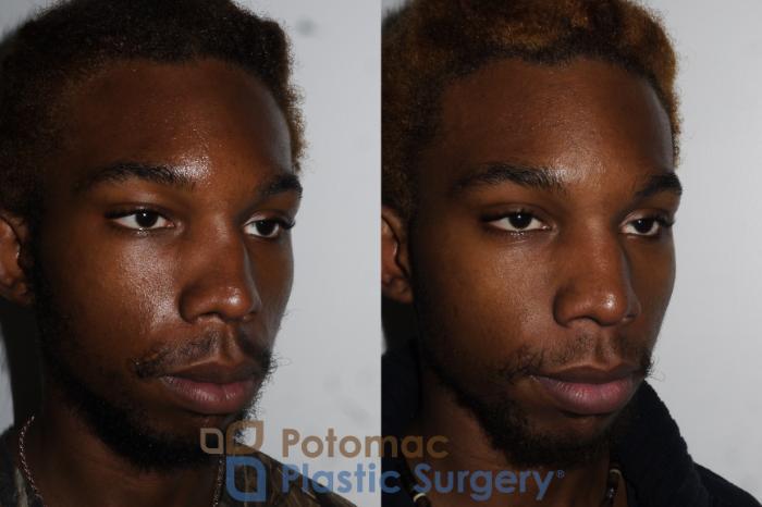 Before & After Rhinoplasty - Medical Case 161 Right Oblique View in Washington DC & Arlington , DC
