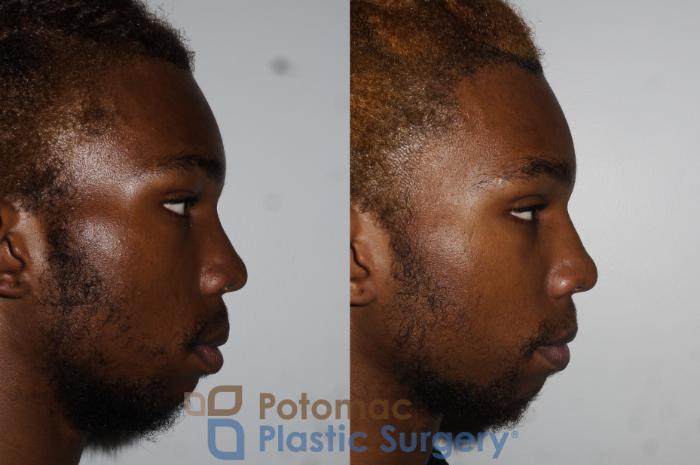 Before & After Rhinoplasty - Cosmetic Case 161 Right Side View in Washington, DC