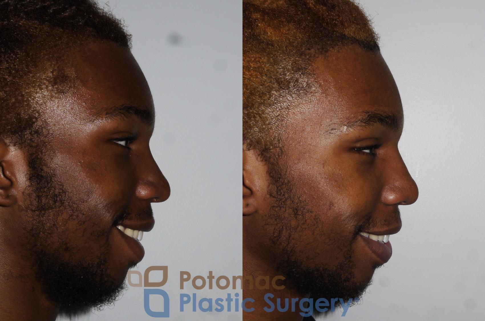 Before & After Rhinoplasty - Cosmetic Case 161 Right View #2 View in Washington DC & Arlington , DC