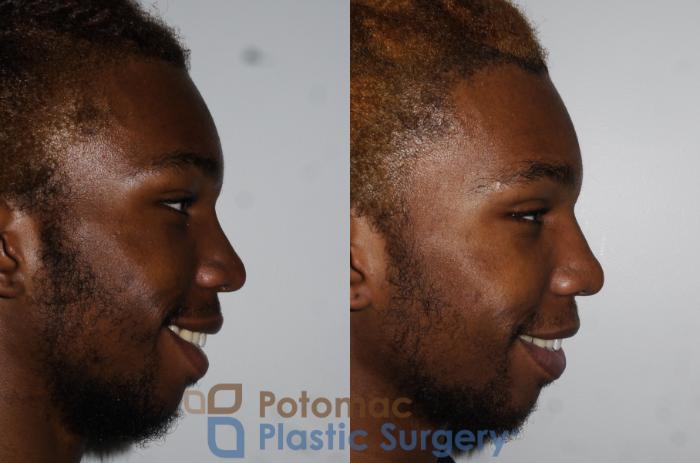 Before & After Rhinoplasty - Medical Case 161 Right View #2 View in Washington DC & Arlington , DC