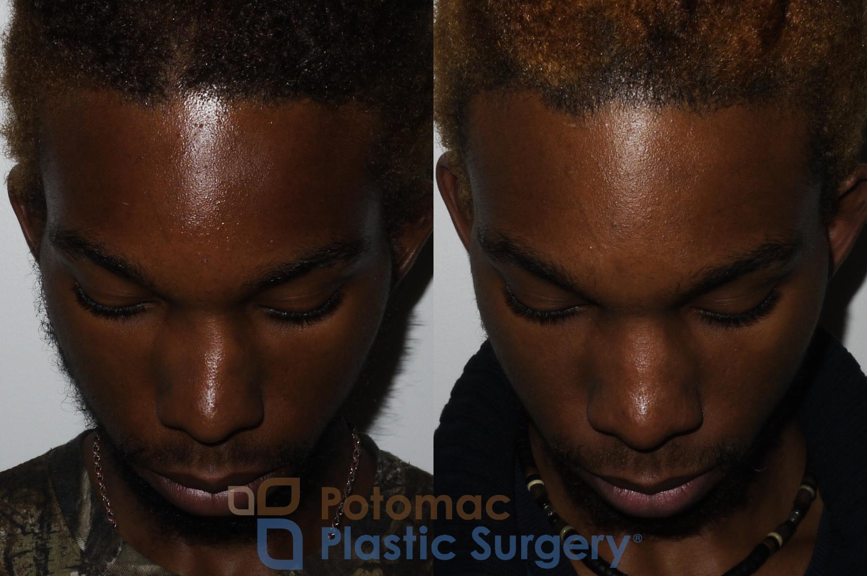 Before & After Rhinoplasty - Cosmetic Case 161 Top View in Washington DC & Arlington , DC