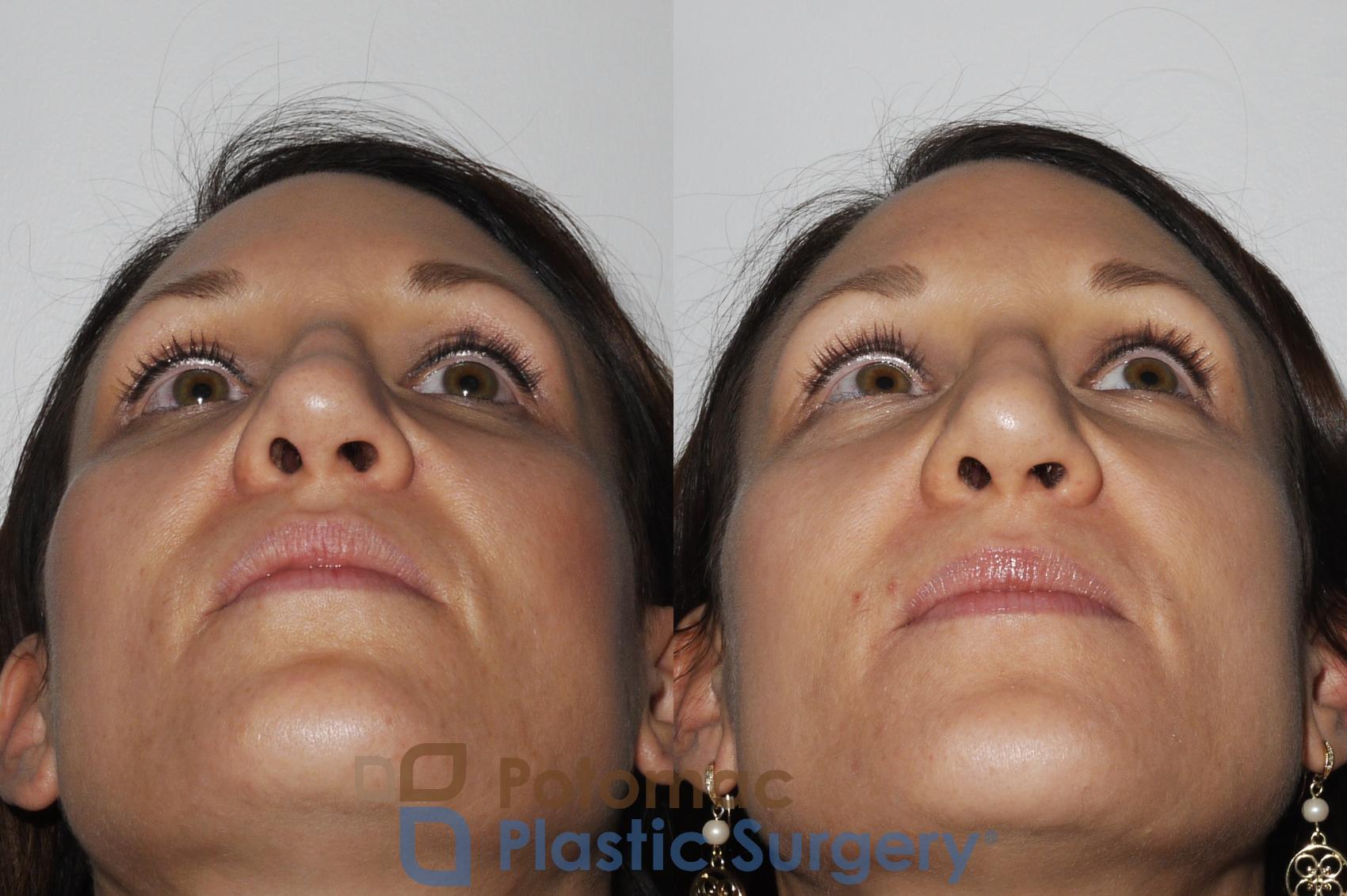 Before & After Rhinoplasty - Cosmetic Case 164 Bottom View in Washington DC & Arlington , DC
