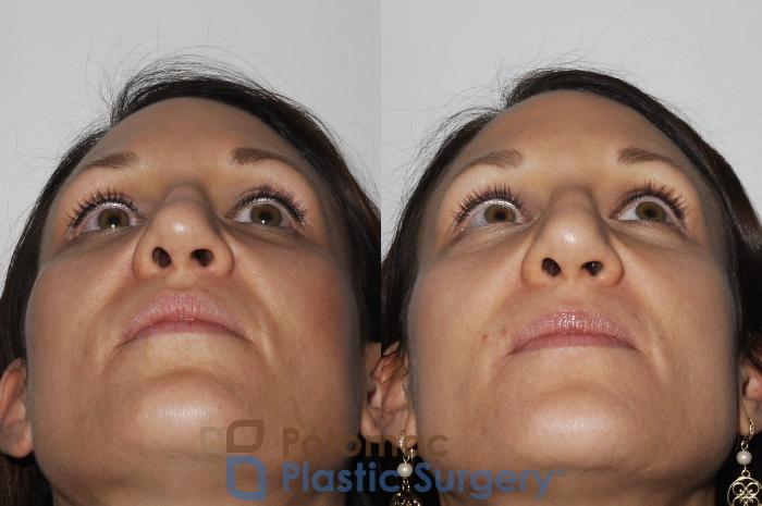 Before & After Rhinoplasty - Cosmetic Case 164 Bottom View in Washington DC & Arlington , DC