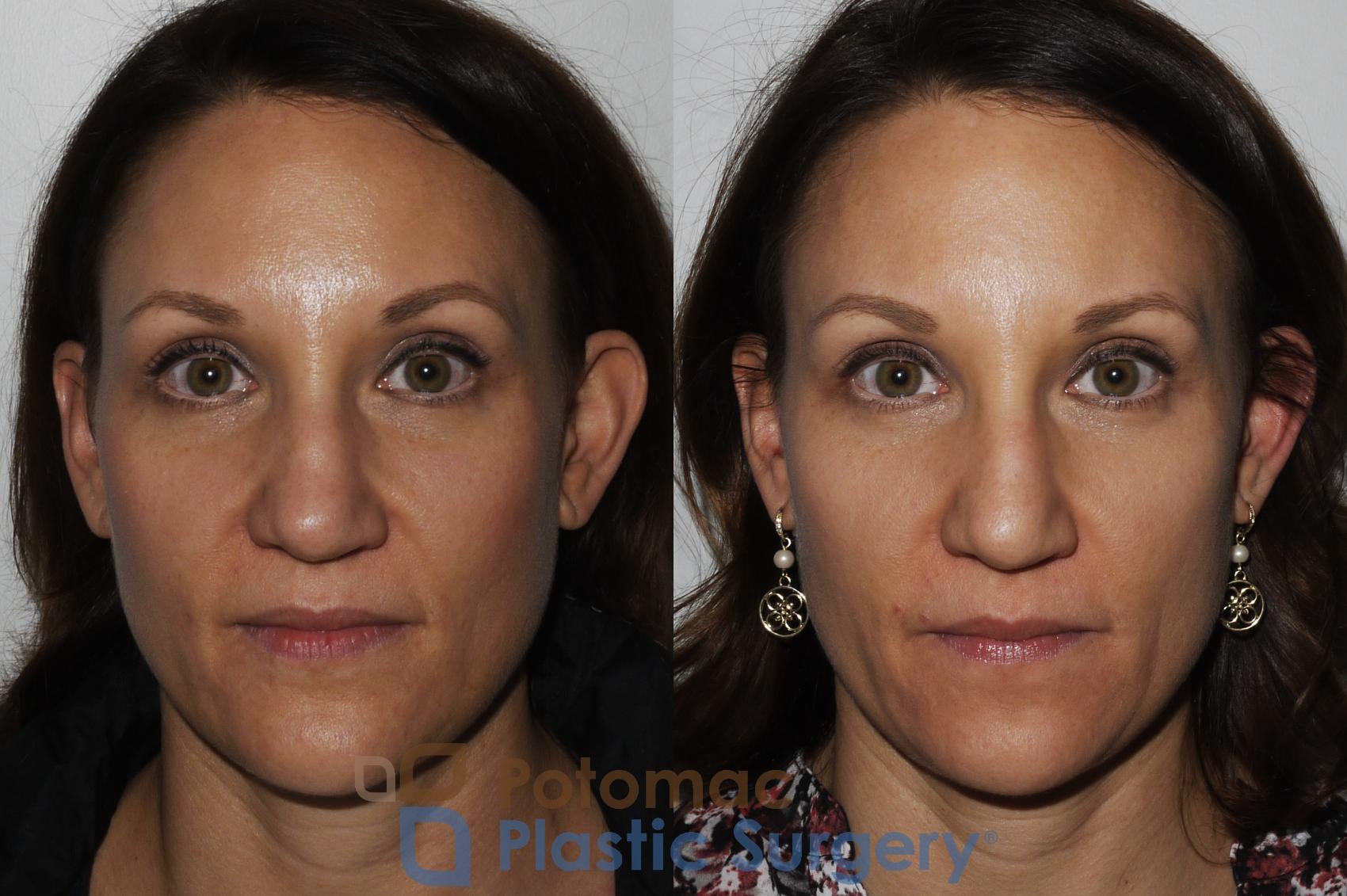 Before & After Liquid Facelift Case 164 Front View in Washington DC & Arlington , DC