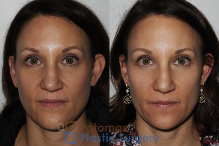 Before & After Rhinoplasty - Cosmetic Case 164 Front View in Washington DC & Arlington , DC