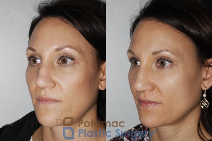 Before & After Rhinoplasty - Cosmetic Case 164 Left Oblique View in Washington DC & Arlington , DC