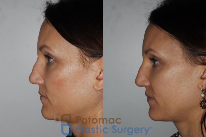 Before & After Rhinoplasty - Cosmetic Case 164 Left Side View in Washington DC & Arlington , DC