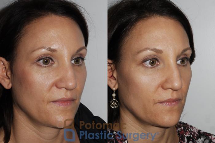 Before & After Rhinoplasty - Cosmetic Case 164 Right Oblique View in Washington DC & Arlington , DC