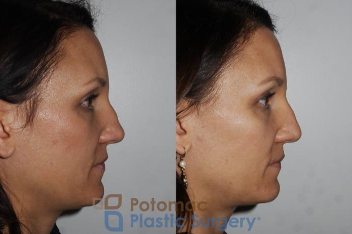 Before & After Rhinoplasty - Cosmetic Case 164 Right Side View in Washington DC & Arlington , DC