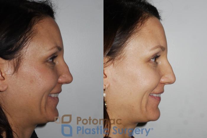 Before & After Dermal Fillers Case 164 Right View #2 View in Washington DC & Arlington , DC
