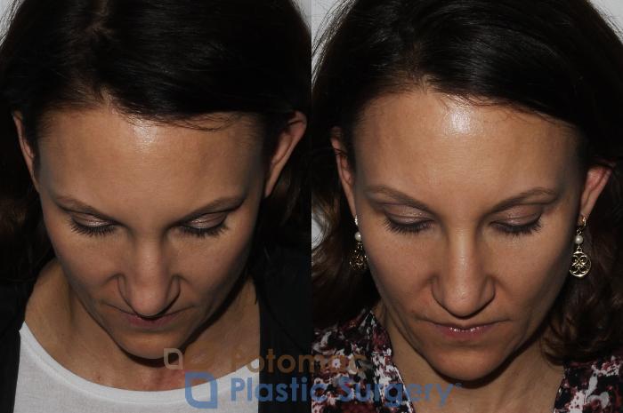 Before & After Dermal Fillers Case 164 Top View in Washington DC & Arlington , DC