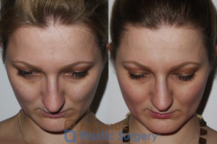 Before & After Rhinoplasty - Medical Case 175 Above View in Washington DC & Arlington , DC