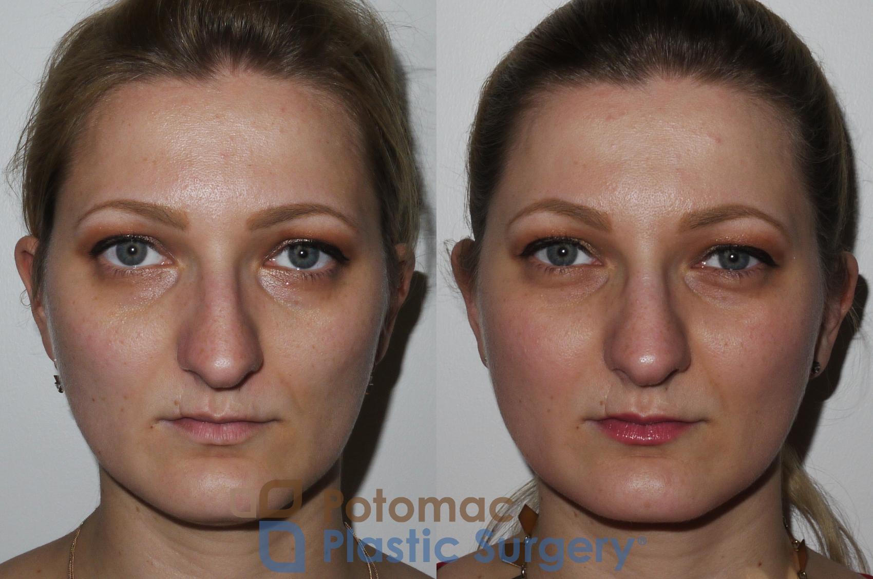 Before & After Rhinoplasty - Medical Case 175 Front View in Washington DC & Arlington , DC